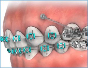 Anchorage Device Mountain View Orthodontics Longmont Berthoud CO