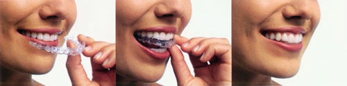 invisalign2