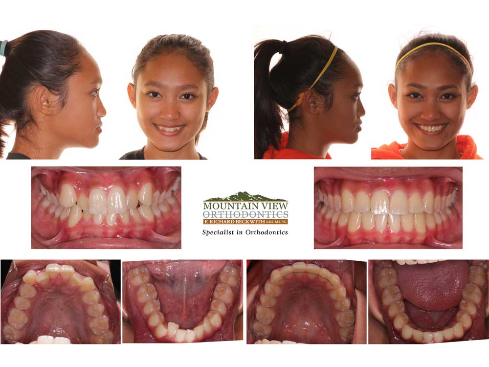 Anastasia Before and After Mountain View Orthodontics Longmont Berthoud CO