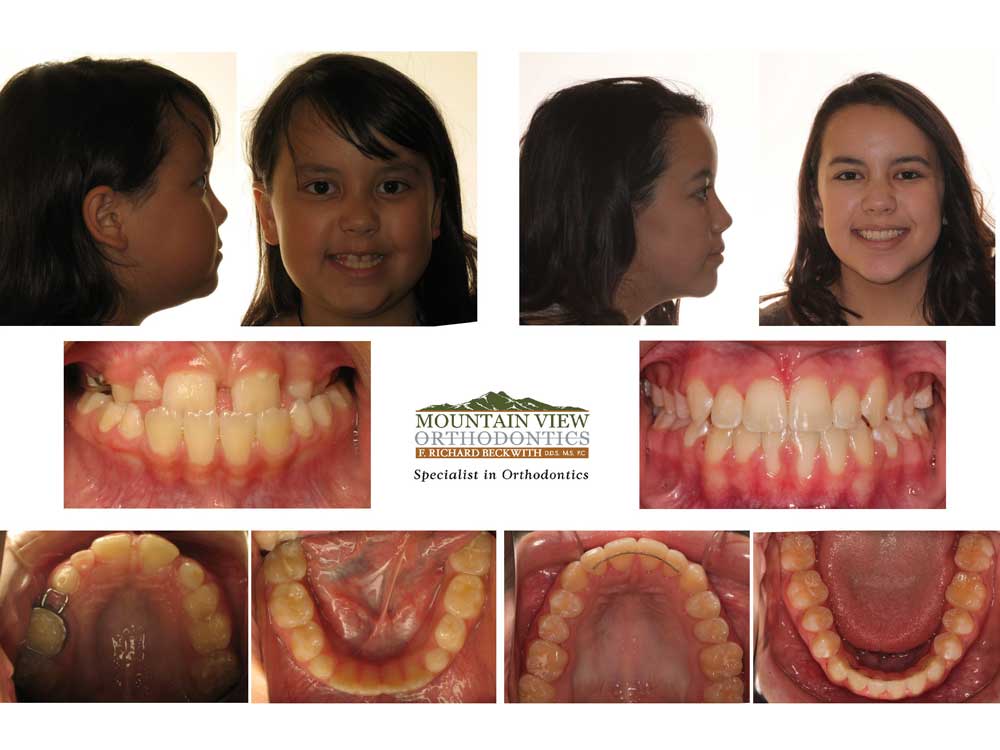 Audrey-Before-and-After-Mountain-View-Orthodontics