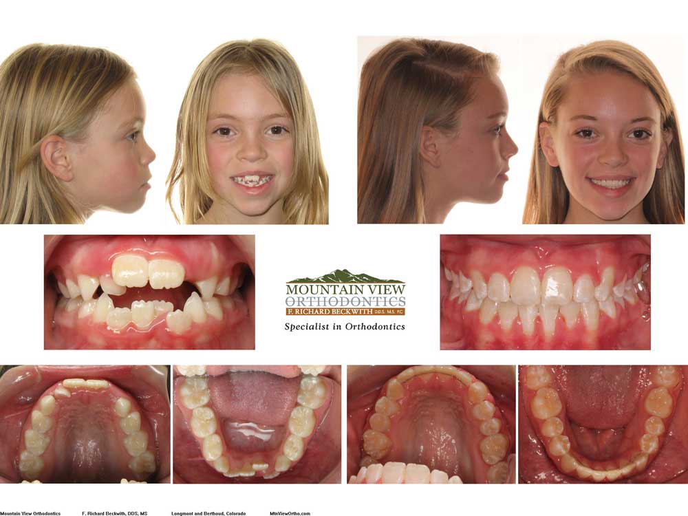 Deep Overbite Before And After  Braces before and after, Misaligned teeth,  After braces