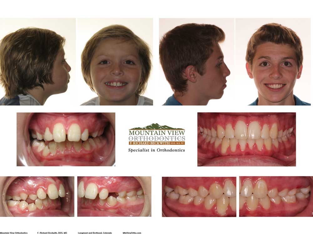 James-Before-and-After-Mountain-View-Orthodontics