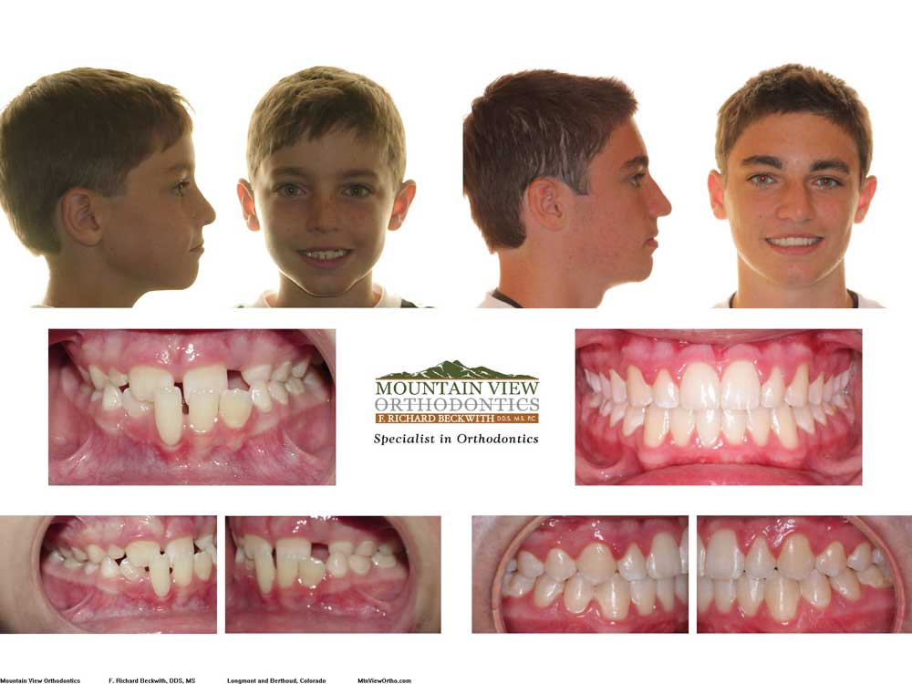 braces before and after open bite