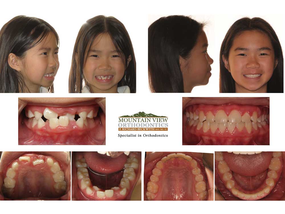 Invisalign Treatment Examples Longmont Berthoud CO Mountain View