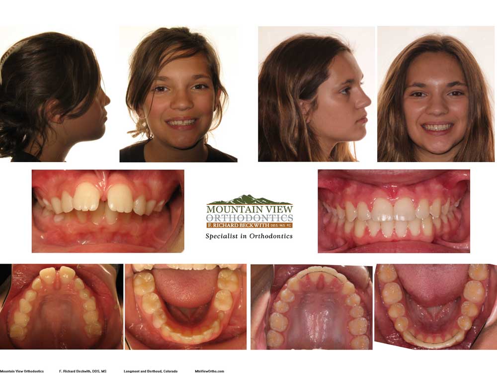 braces before and after gap