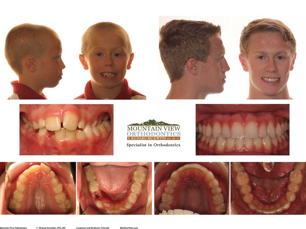 Zack-Before-and-After-Mountain-View-Orthodontics