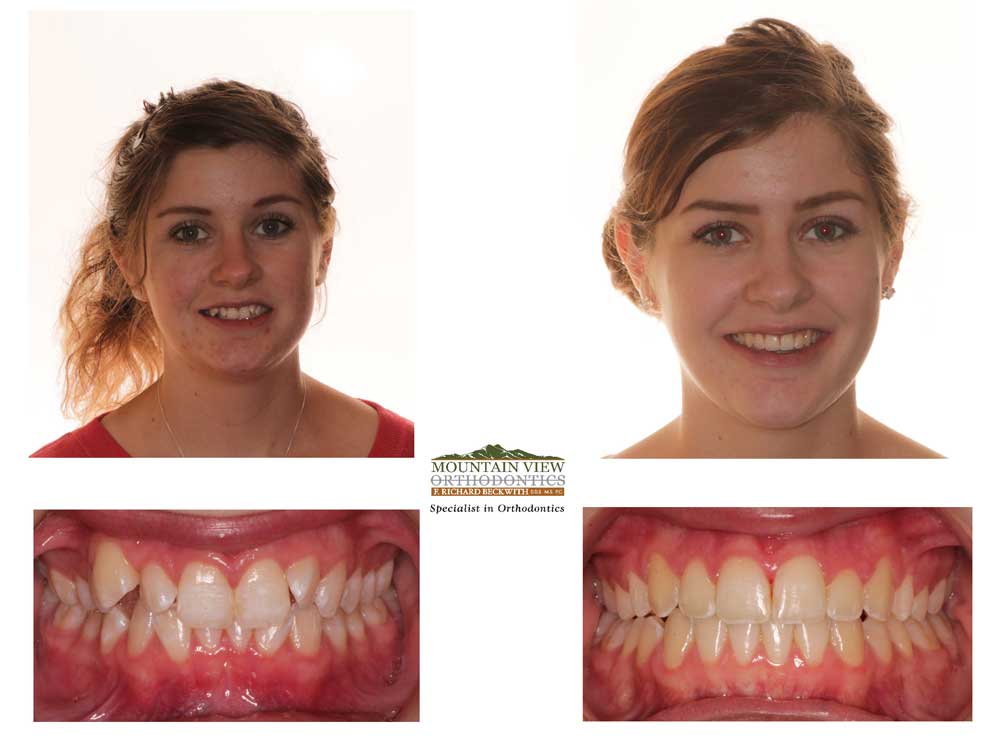 Invisalign Treatment Examples Longmont Berthoud CO Mountain View