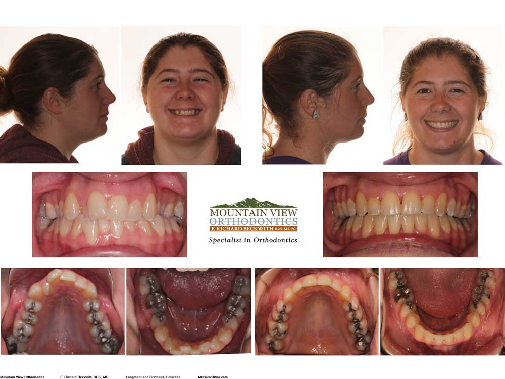 before and after braces overbite profile