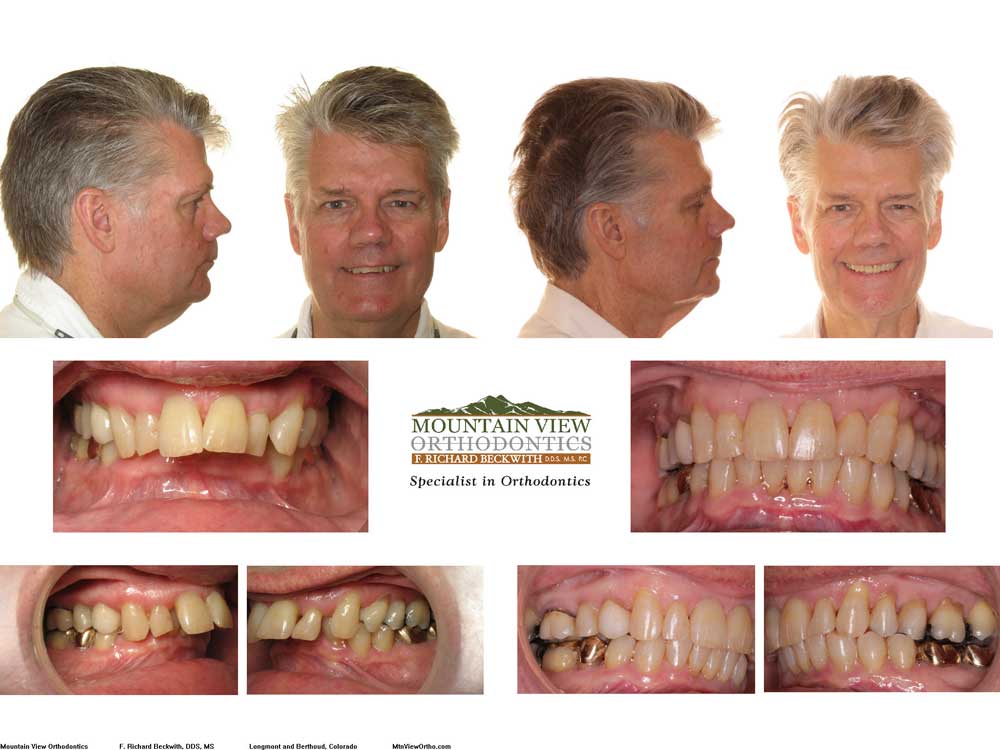 before and after braces adults