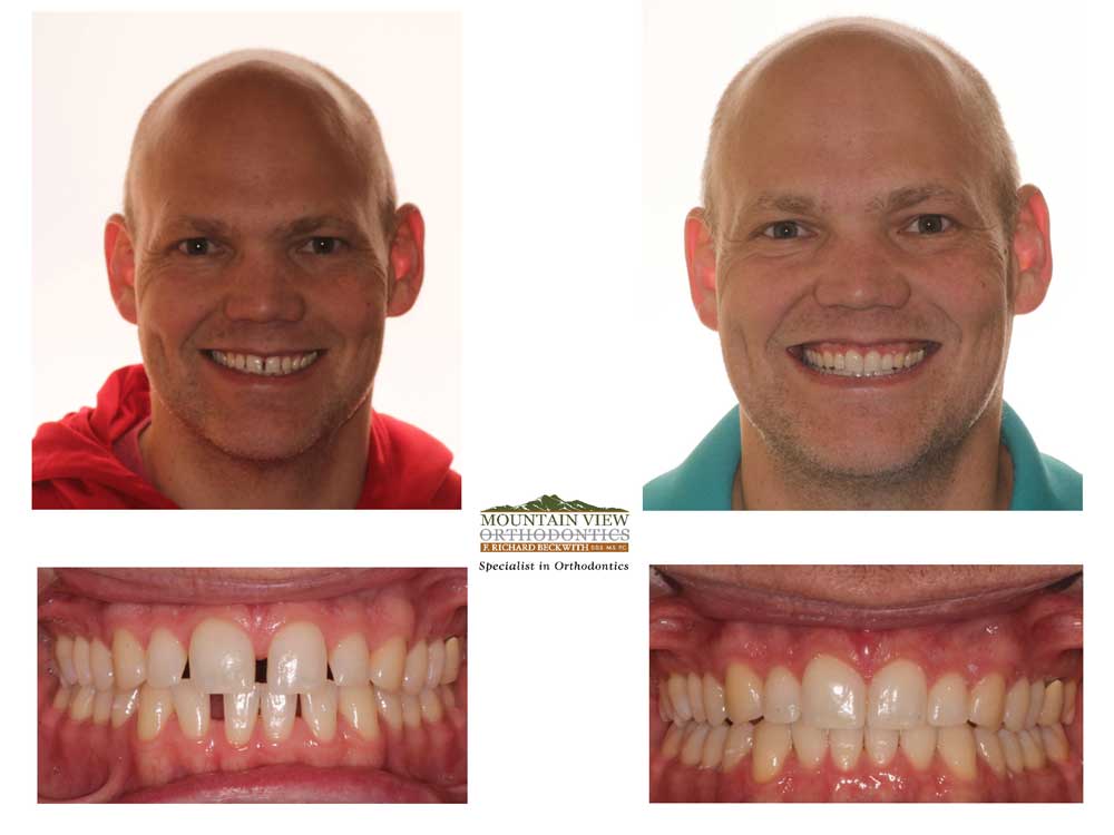 Sam Before and After Mountain View Orthodontics Longmont Berthoud CO