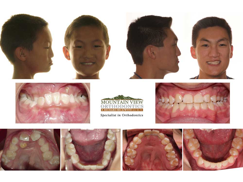 Cameron-Before-and-After-Mountain-View-Orthodontics