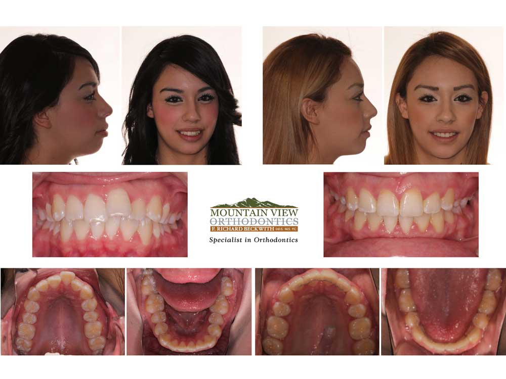 Carmen-Before-and-After-Mountain-View-Orthodontics