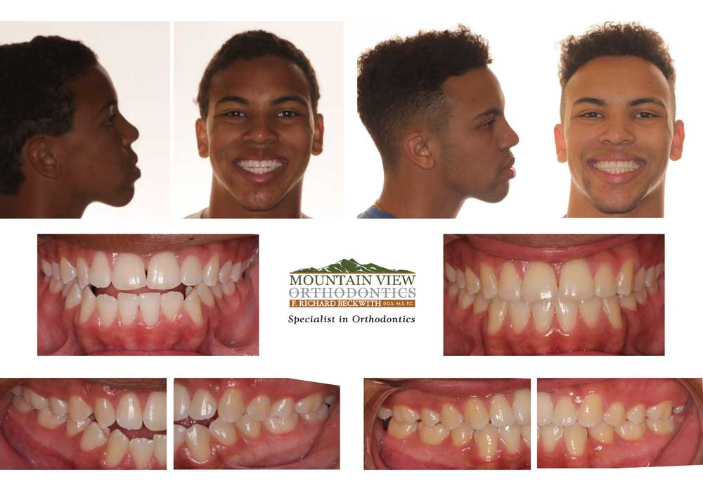 before and after braces overbite profile