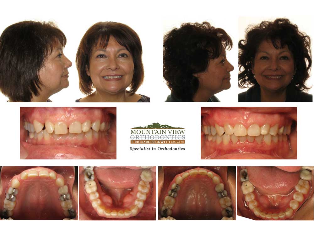 Edwina-Before-and-After-Mountain-View-Orthodontics