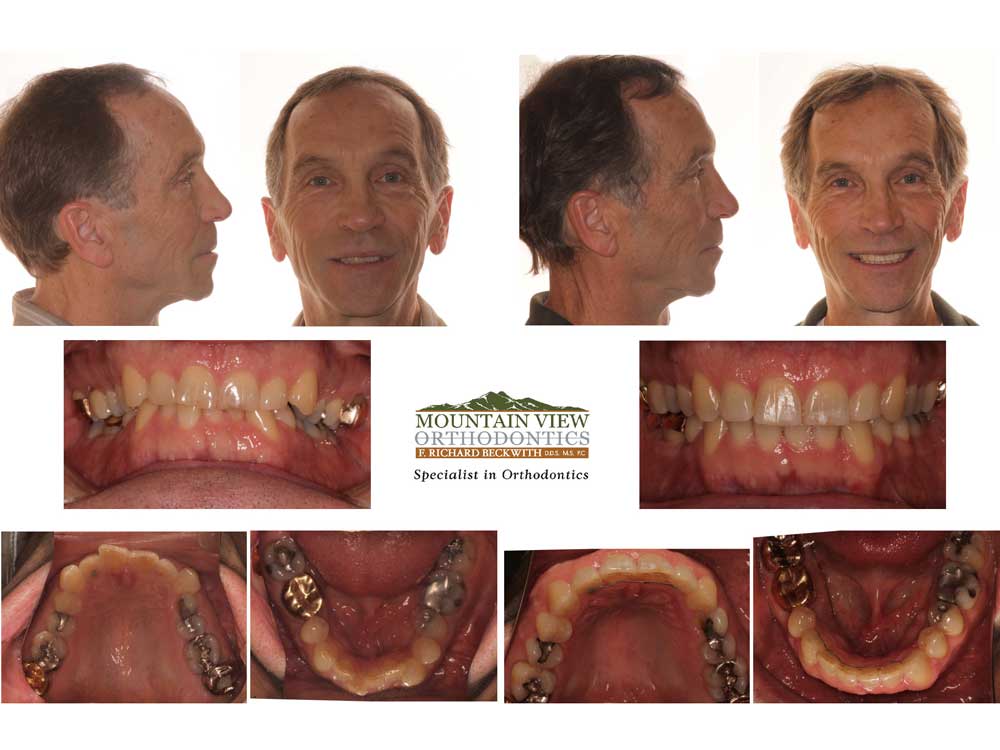 Invisalign Treatment Examples Longmont Berthoud CO Mountain View  Orthodontics