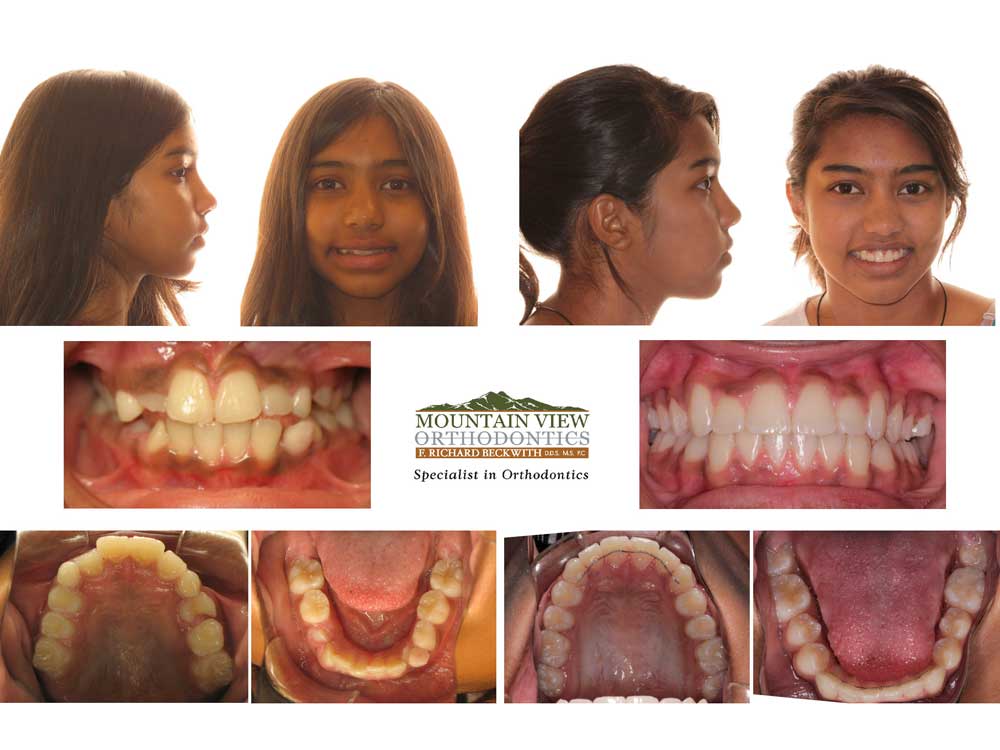 Humsini-Before-and-After-Mountain-View-Orthodontics