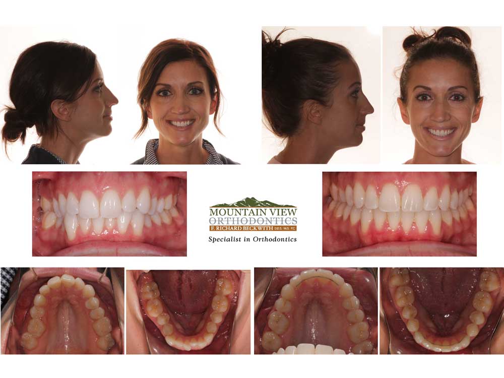 Deep Overbite Before And After  Braces before and after, Misaligned teeth,  After braces