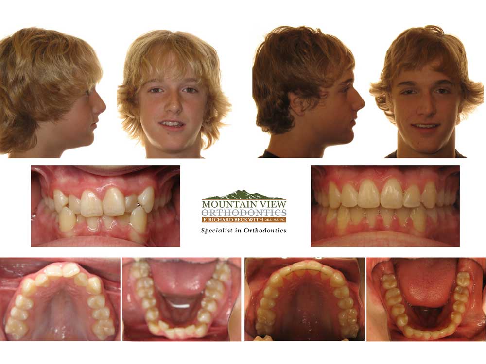 James-Before-and-After-Mountain-View-Orthodontics