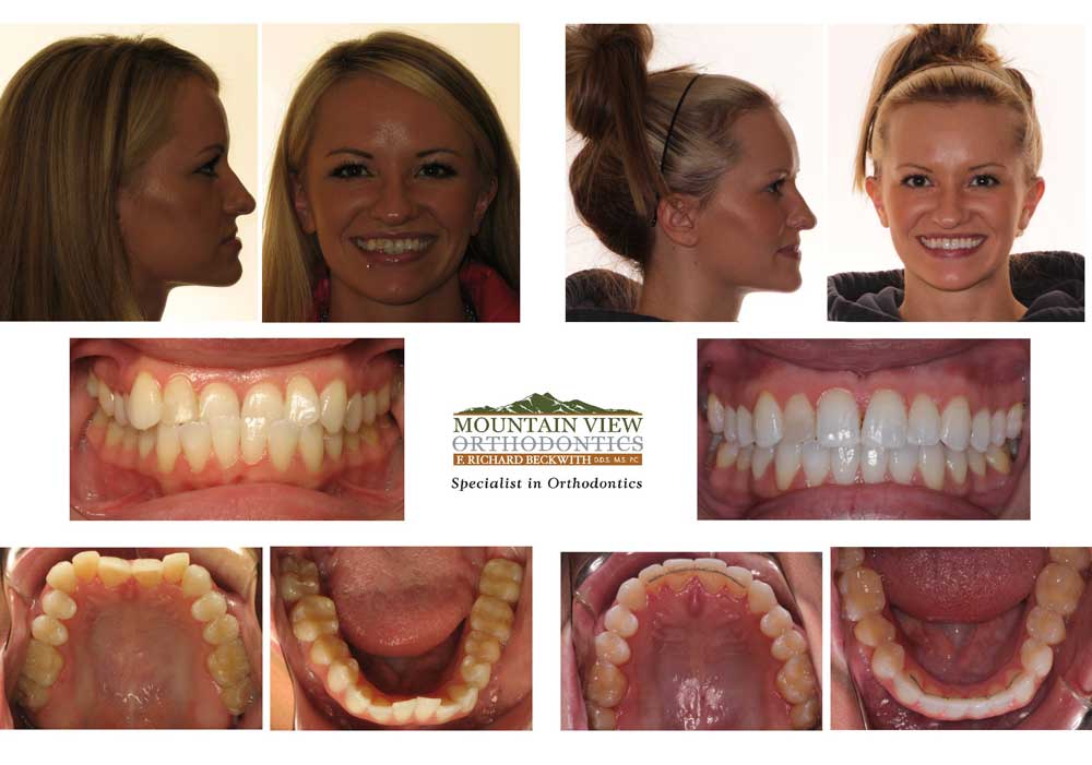 Invisalign Treatment Examples Longmont Berthoud CO Mountain View