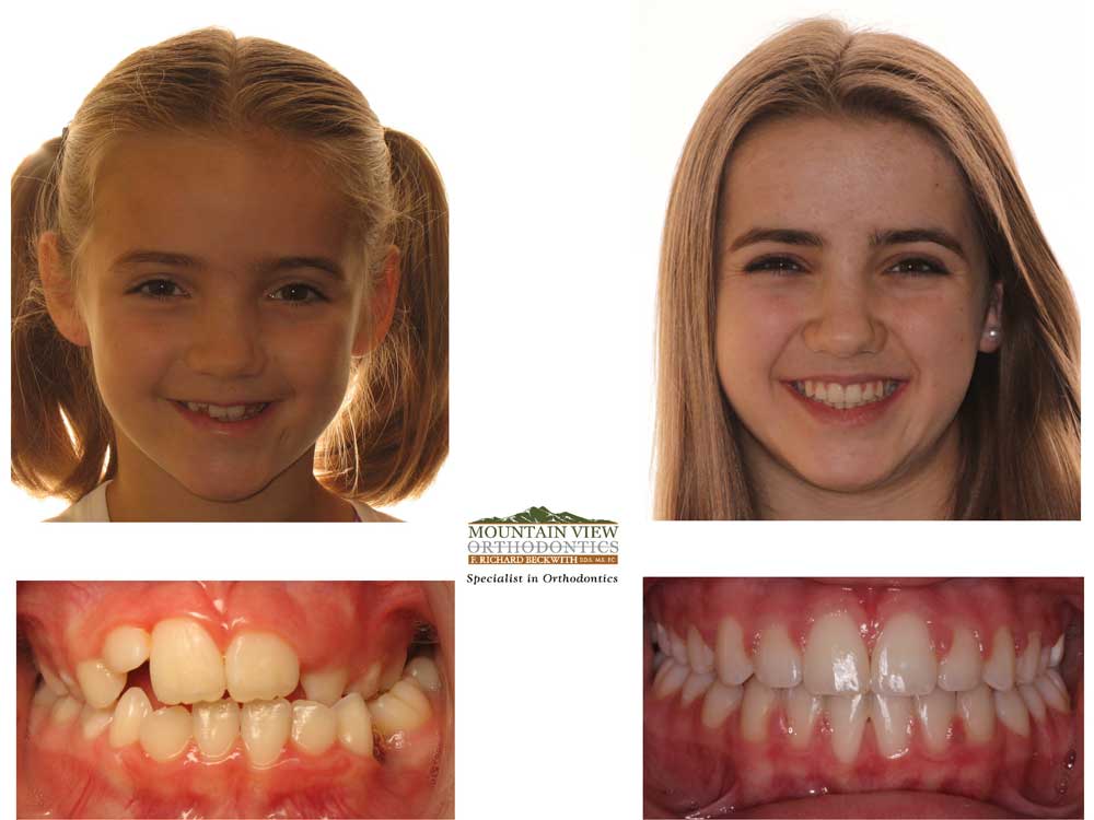 Johannah-Before-and-After-Mountain-View-Orthodontics