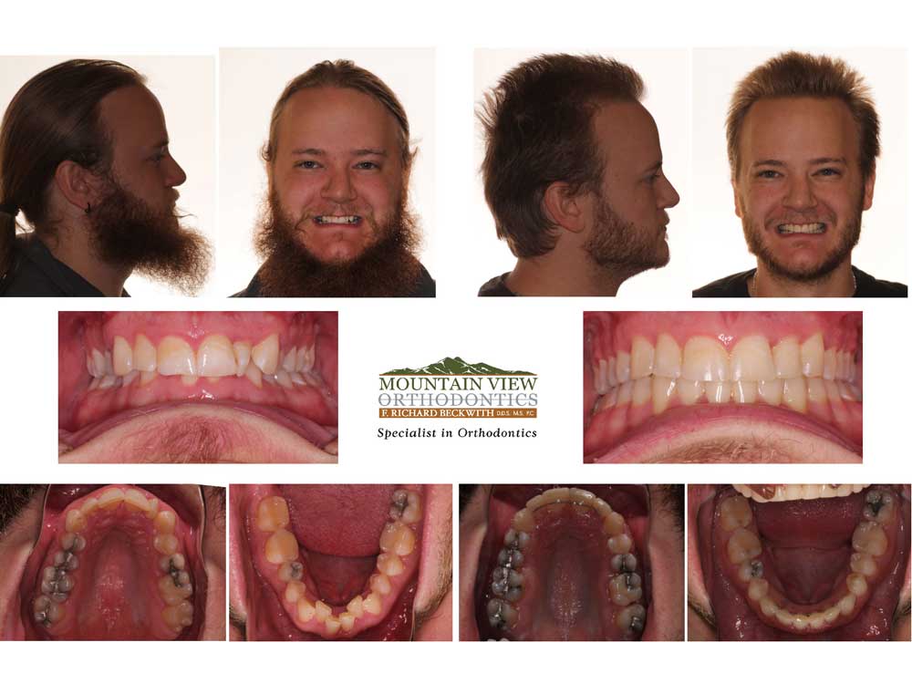 Deep Overbite Before And After  Braces before and after, Misaligned teeth,  After braces