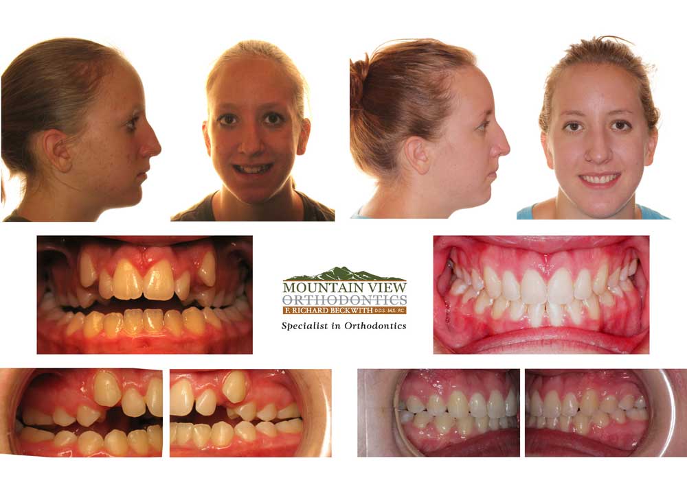 Deep Overbite Before And After