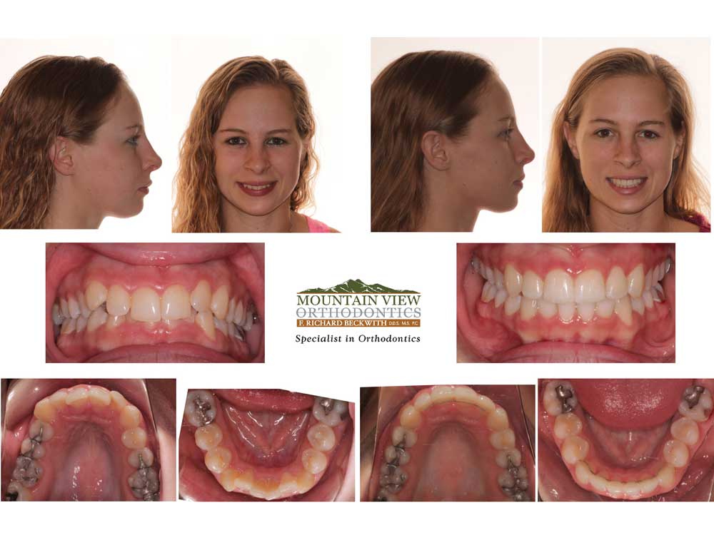 Invisalign (Invisalign) - Profile