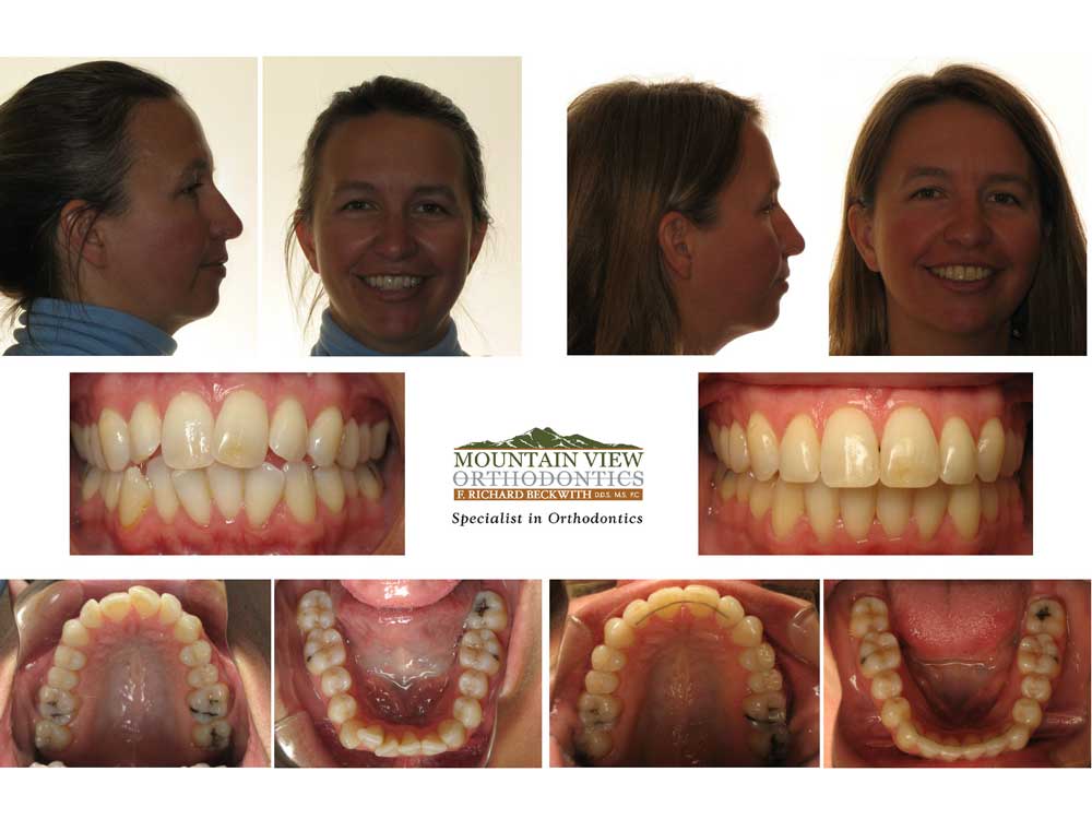 before and after braces overbite profile