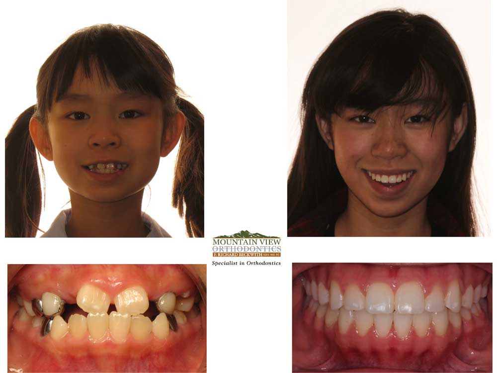 Michelle-Before-and-After-Mountain-View-Orthodontics