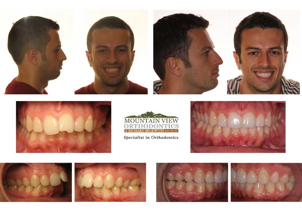 before and after braces overbite profile