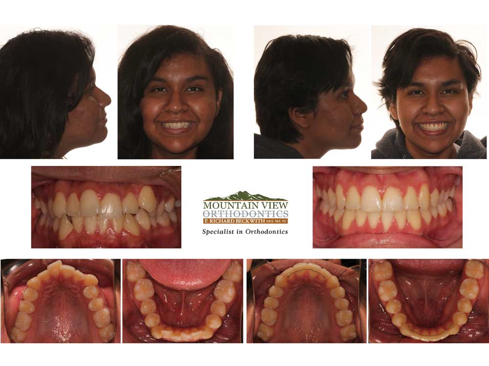 Sky-Before-and-After-Mountain-View-Orthodontics