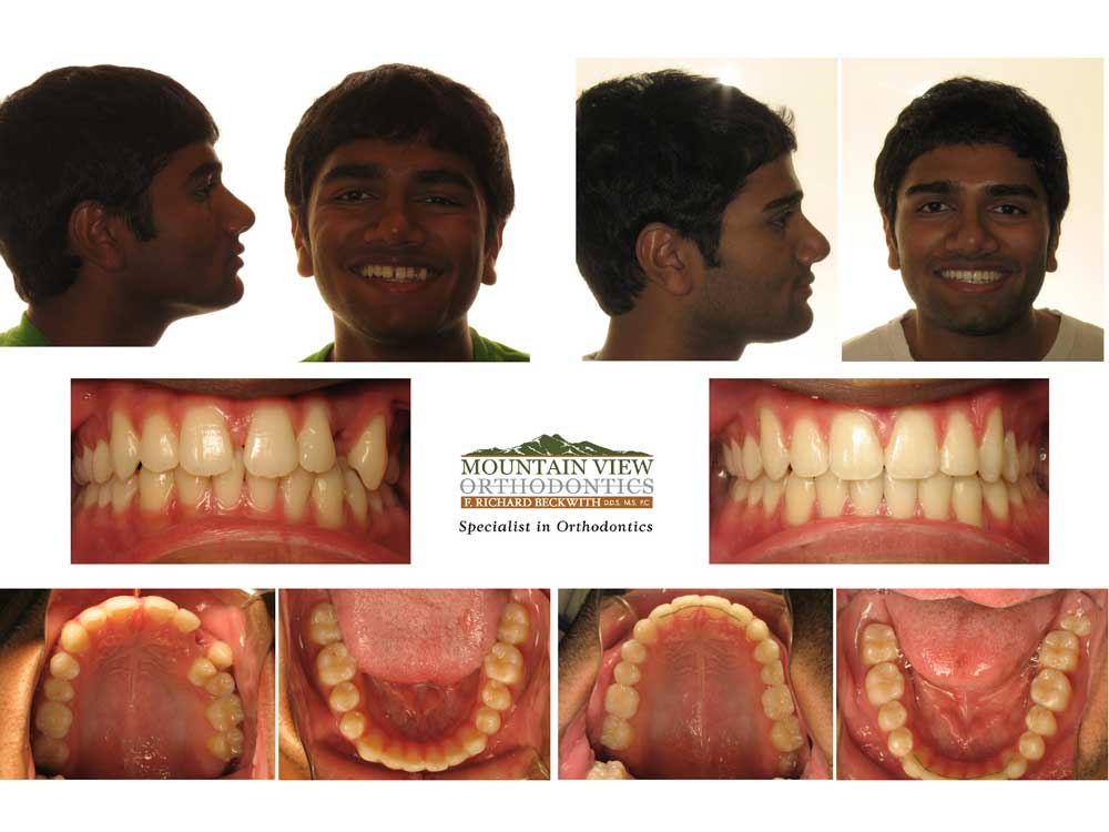 Varun-Before-and-After-Mountain-View-Orthodontics