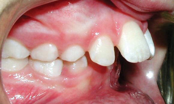 Protrusion Mountain View Orthodontics in Longmont and Berthoud, CO