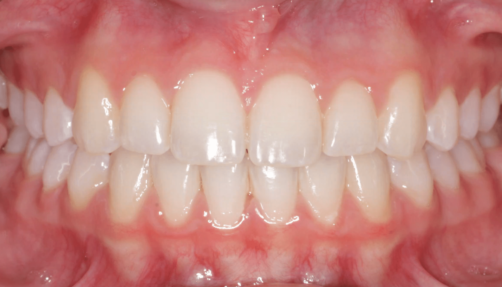 Frontal Crowding After Orthodontic Treatment Mountain View Orthodontics in Longmont and Berthoud, CO