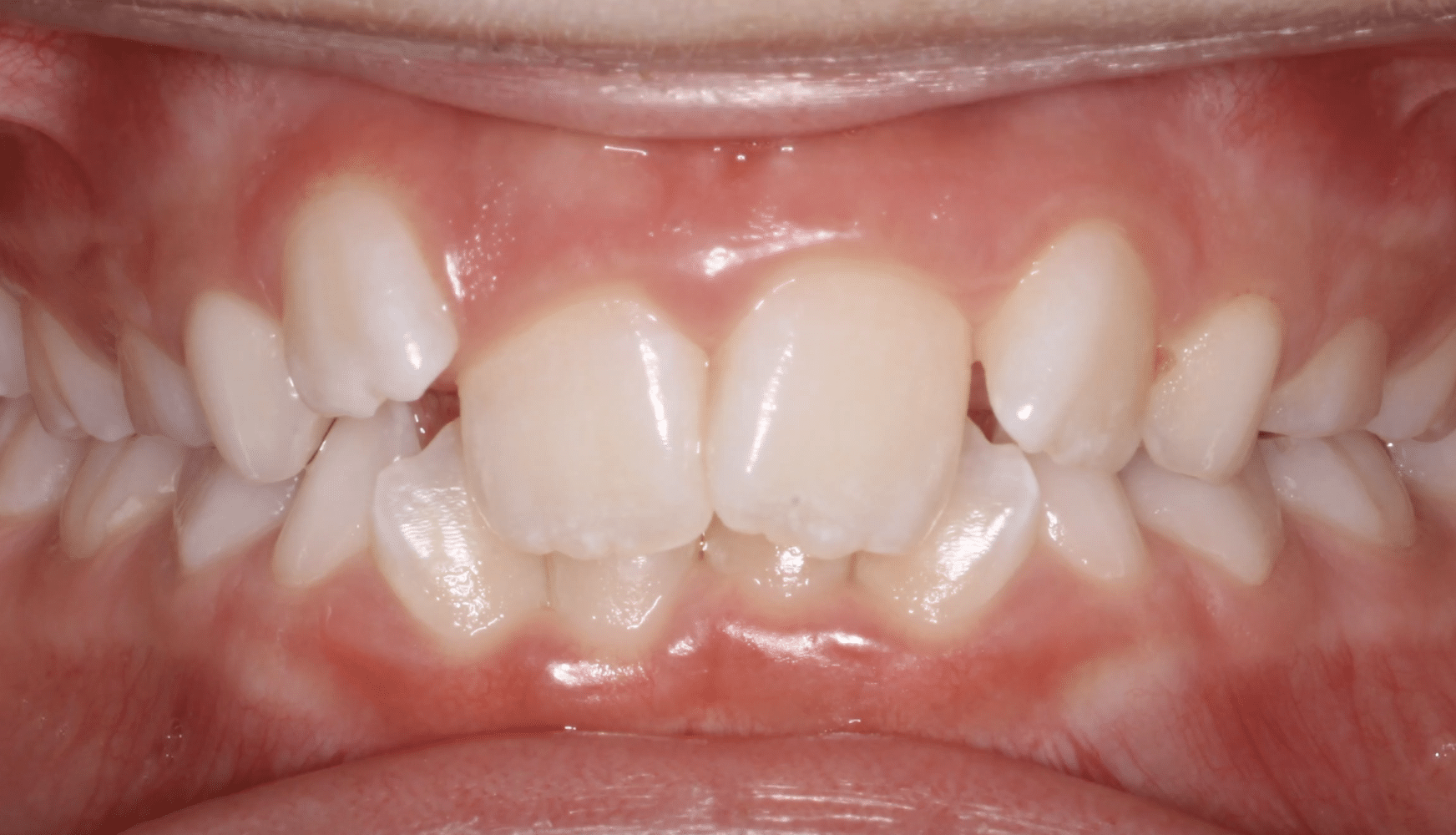 Frontal Crowding Before Orthodontic Treatment Mountain View Orthodontics in Longmont and Berthoud, CO