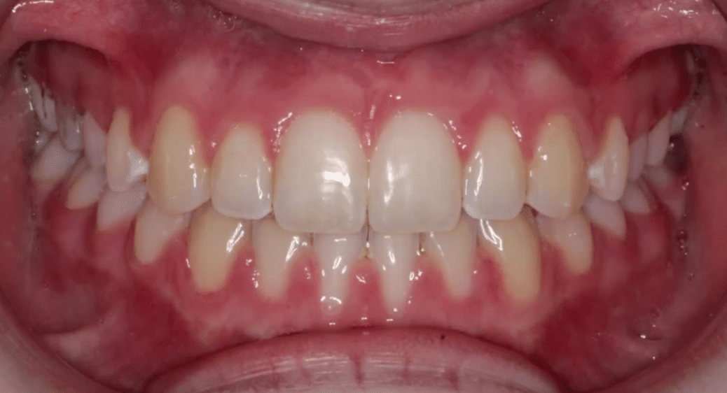 Frontal Spacing After Orthodontic Treatment Mountain View Orthodontics in Longmont and Berthoud, CO