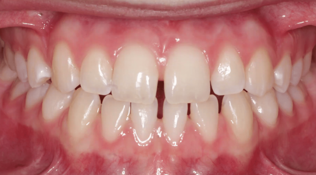 Frontal Spacing Before Orthodontic Treatment Mountain View Orthodontics in Longmont and Berthoud, CO