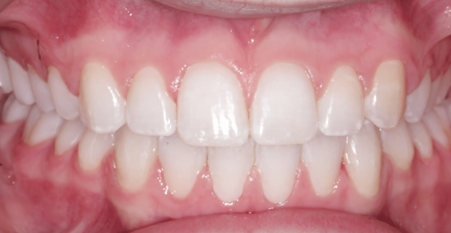 Frontal Canine After Orthodontic Treatment Mountain View Orthodontics in Longmont and Berthoud, CO