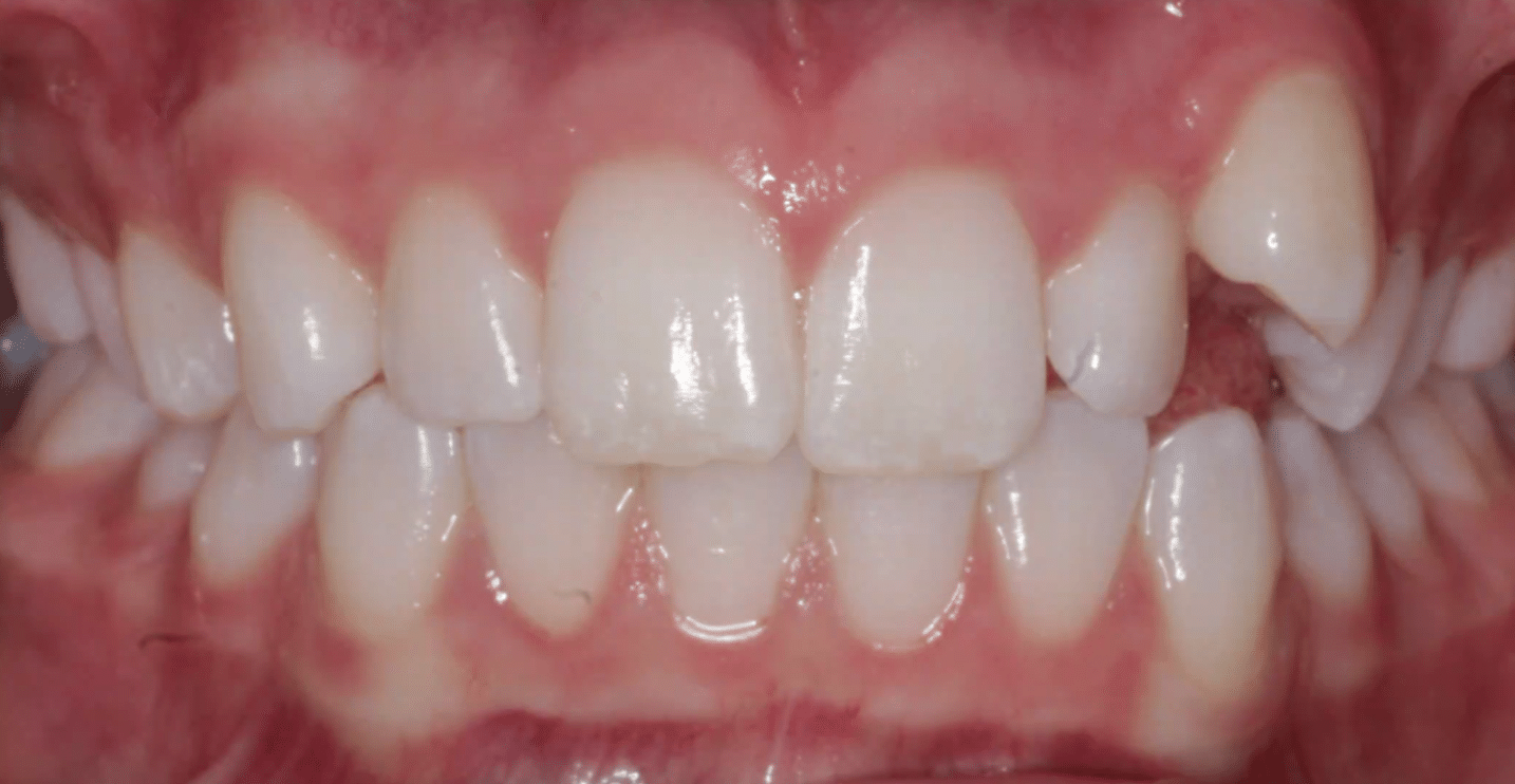 Frontal Canine Before Orthodontic Treatment Mountain View Orthodontics in Longmont and Berthoud, CO