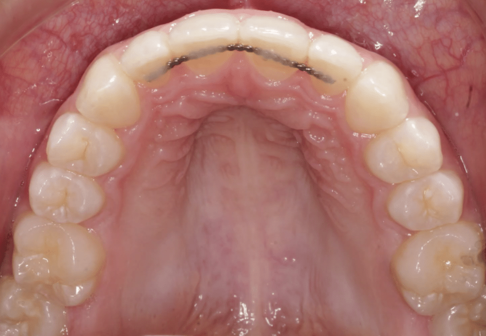 Upper Crowding After Orthodontic Treatment Mountain View Orthodontics in Longmont and Berthoud, CO