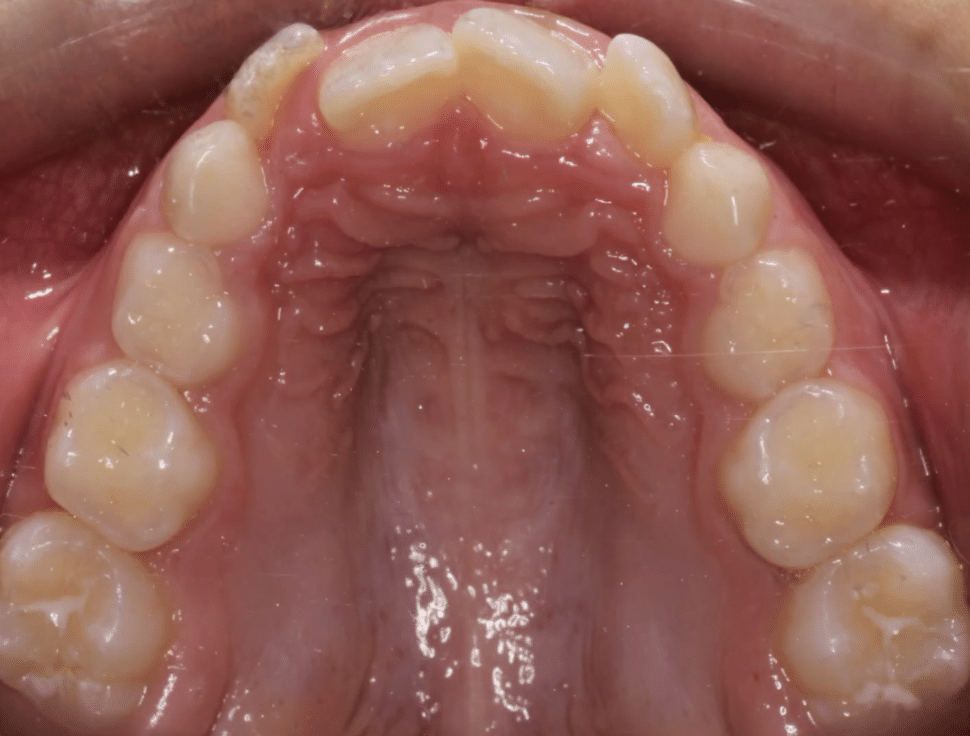Upper Crowding Before Orthodontic Treatment Mountain View Orthodontics in Longmont and Berthoud, CO