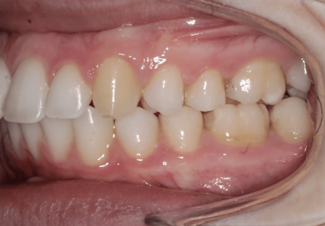 Bite Problem After Orthodontic Treatment Mountain View Orthodontics in Longmont and Berthoud, CO