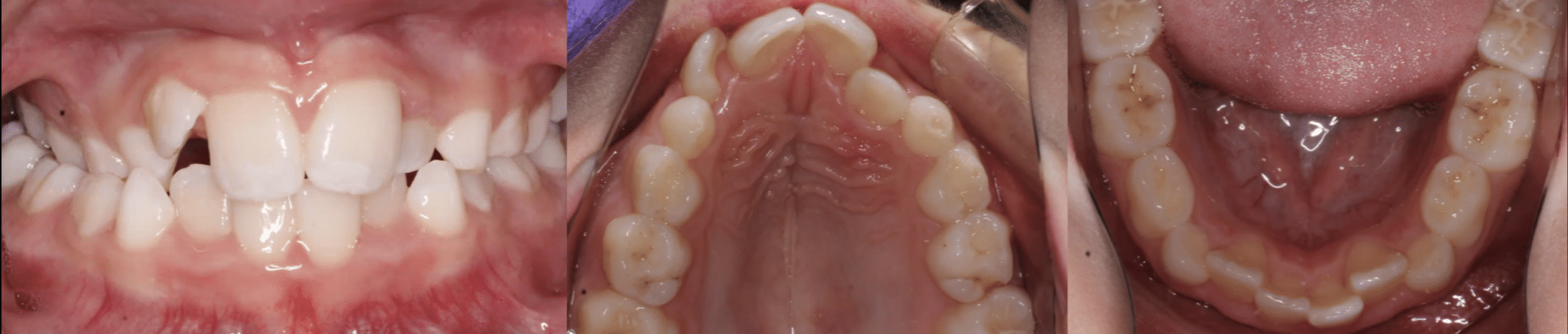 Crossbite Before Orthodontic Treatment Mountain View Orthodontics in Longmont and Berthoud, CO