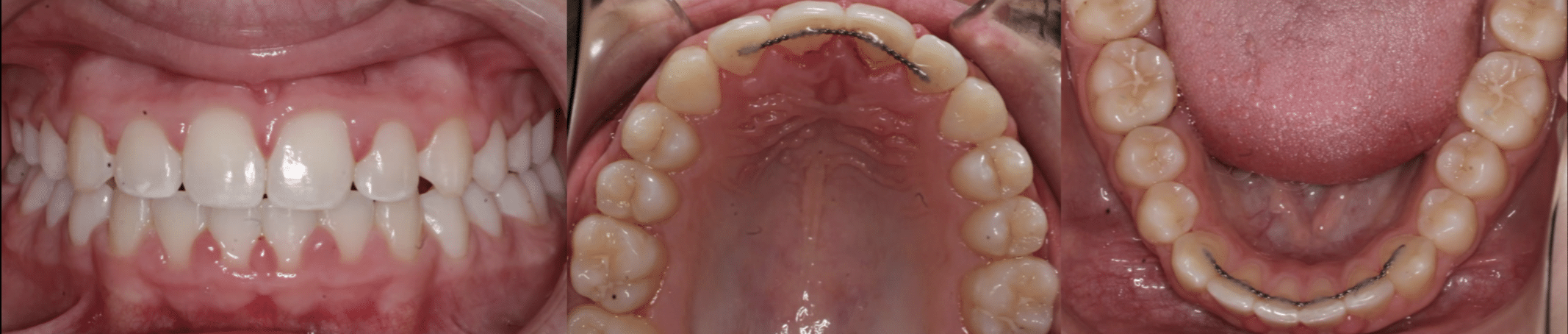 Crossbite After Orthodontic Treatment Mountain View Orthodontics in Longmont and Berthoud, CO